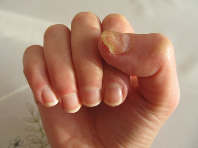 Nail fungus.jpg