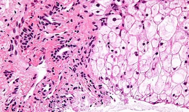 Glycogen_storage_disease_in_liver_By-NephronWikimedia-Commona-30bzls9nxpiyxhwg0bf1fk.jpg