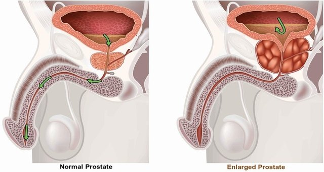 Benign Prostatic Hyperplasia (BPH).jpg