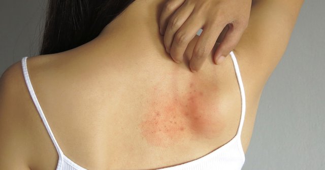 A Skin Rash Might Be a Sign That You Have a Yeast Infection.jpg