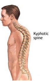 kyphosis-hyp.jpg