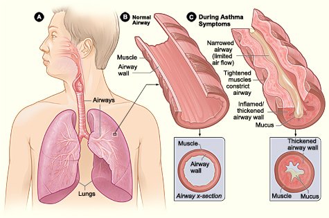 Asthma_attack-illustration_NIH.jpg
