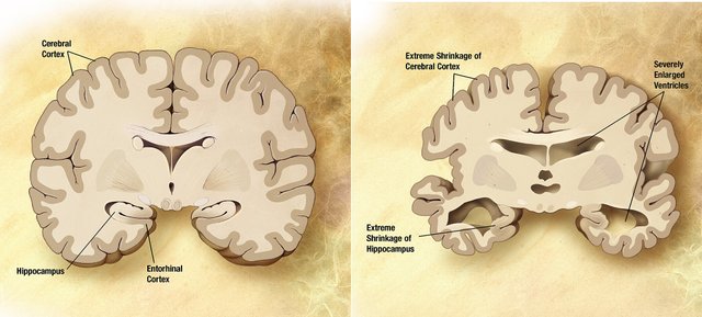 2048px-Alzheimer's_disease_brain_comparison (1).jpg