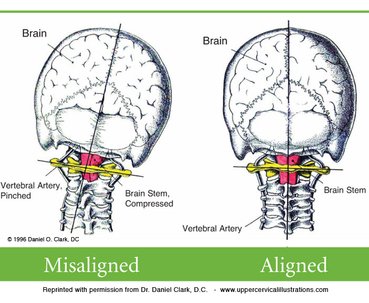 brain-misaligned.jpg