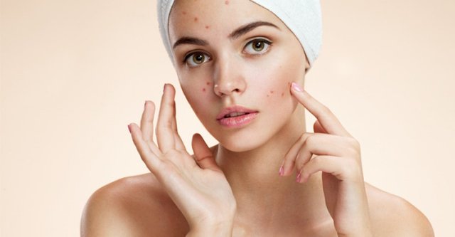 Home-Remedies-to-Get-Rid-of-Pimples-Naturally.jpg