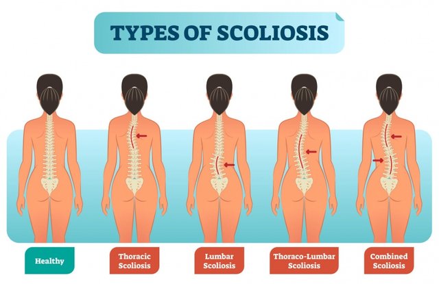 scoliosis_types_100585862_ML.jpg