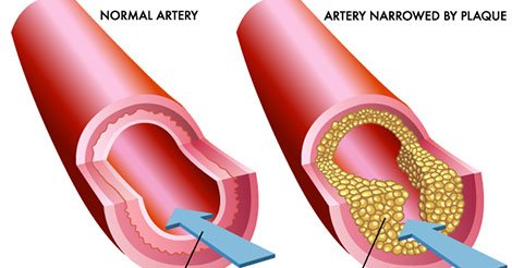 cholesterol.jpg