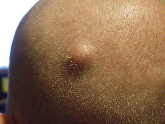 1-cyst-on-head.jpg