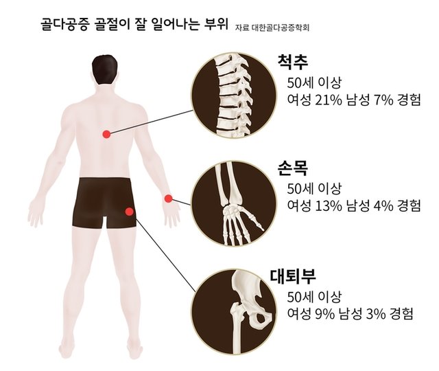 골다공증 한의원 골다공증골절 호발부위 종로한의원 통인.jpg