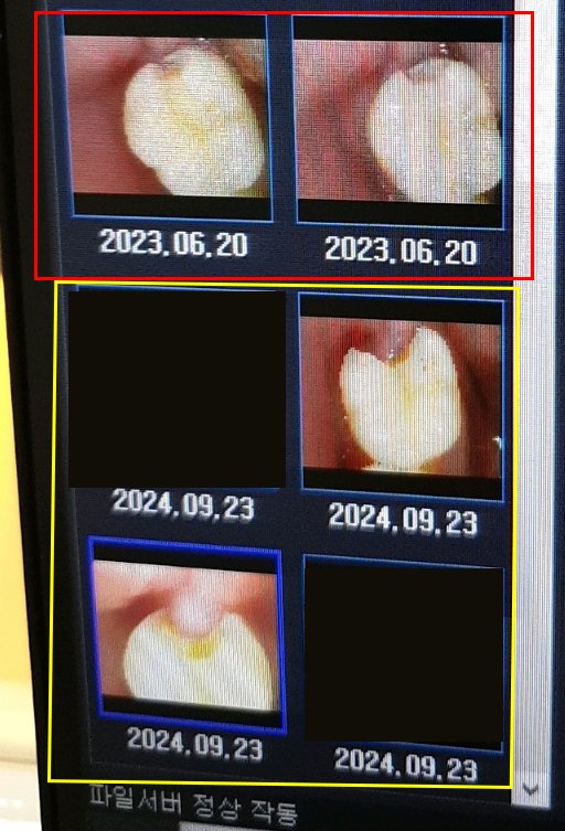 고려치과 나의 치아 사진-11.jpg