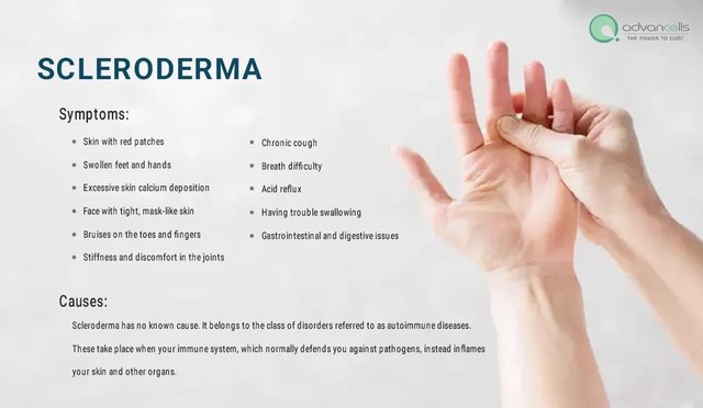 scleroderma-symptoms-causes-treatments-1080x628.jpg