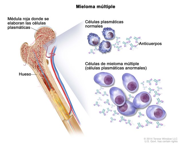 multiplemyeloma-spanish-enlarge.__v500356888.jpg