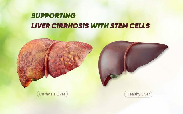 Stem Cell For Liver Disease.jpg