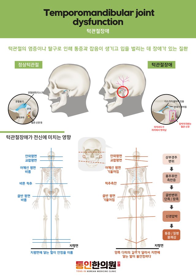 턱관절장애(a4).jpg