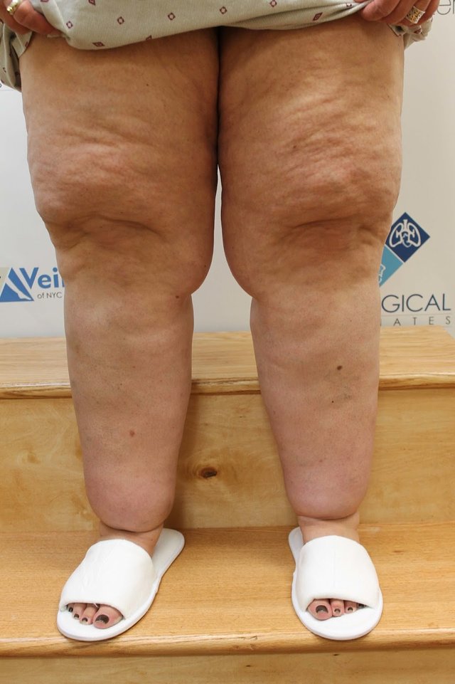Lipedema-patient-Vicki-shows-how-te-disorder-has-affected-her-legs.jpg