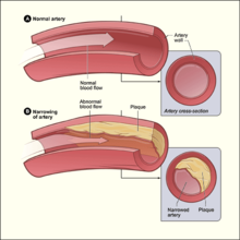 220px-Atherosclerosis_diagram.png