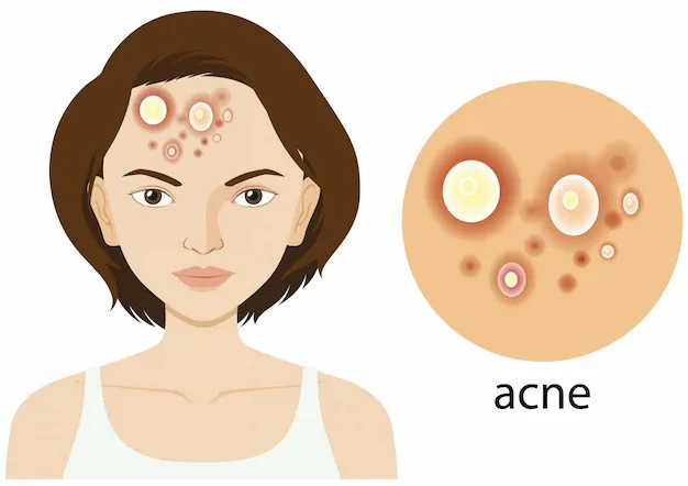 diagram-showing-woman-with-acne-problem_1308-35368.webp