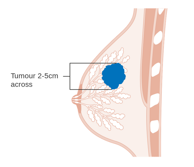 750px-Diagram_showing_stage_T2_breast_cancer_CRUK_252.svg.png