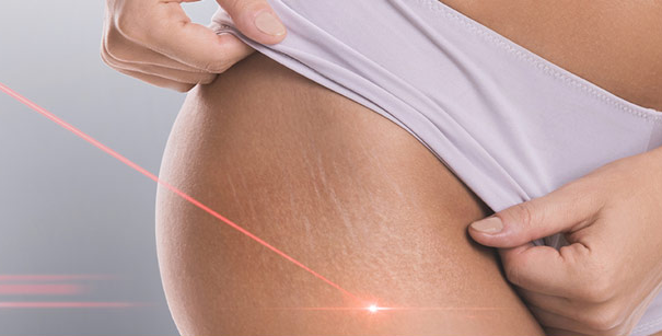 What causes stretch marks.png