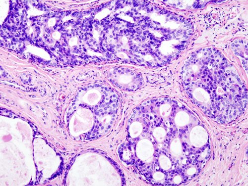 Breast_DCIS_histopathology_(1).jpg