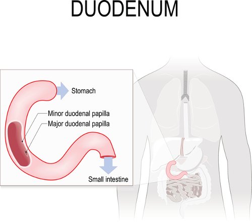 Duodenitis.jpg