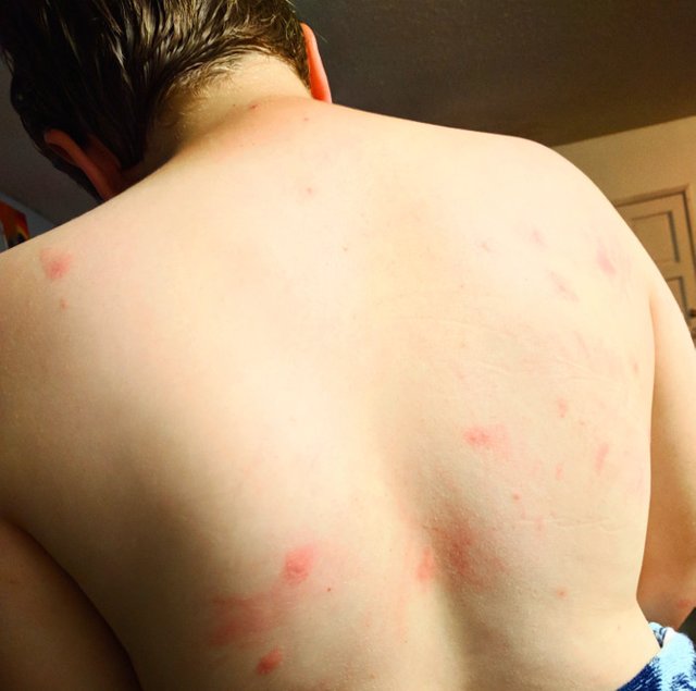 hives back b.jpg