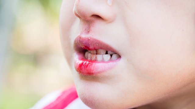 file_main_image_6049_2_blessures_infections_bouche_enfant_6049_01_1500X1000_cache_640x360.jpg