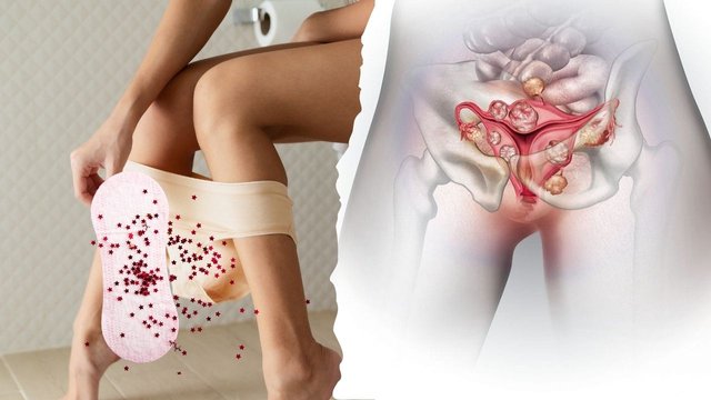 Uterine Fibroids and Heavy Periods.jpg