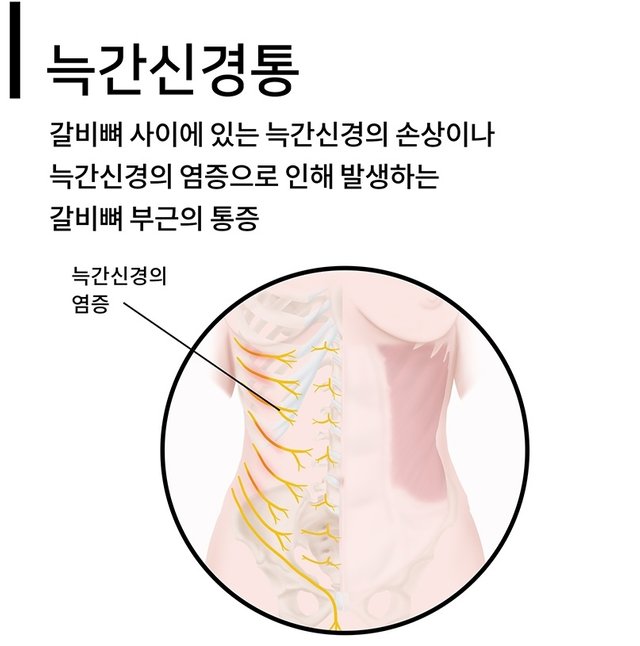 옆구리 통증 늑간신경통 통인한의원.jpg