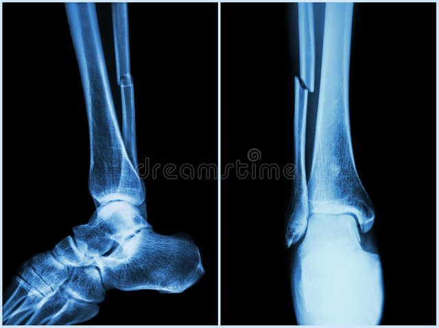 fracture-shaft-fibula-bone-leg-bone-ray-leg-position-side-front-view-49536932.jpg
