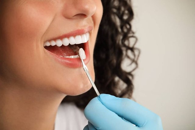 porcelain veneers in Miami fl.jpg