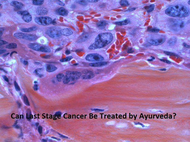 neeraj cancer treatment 2.jpg