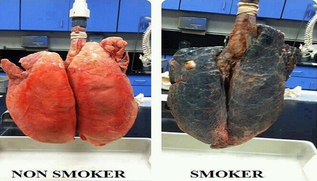 lungs-Netmarkers.jpg