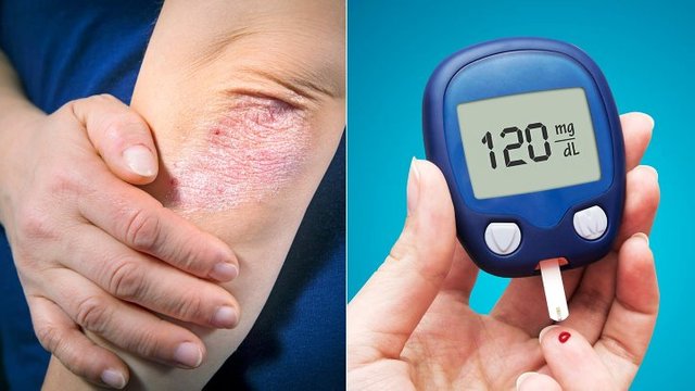 How-Psoriasis-and-Type-2-Diabetes-Are-Linked-1440x810.jpg