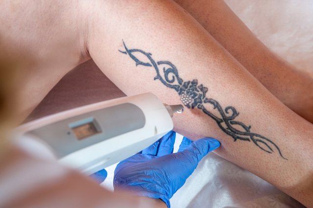 laser tattoo removal office.jpg