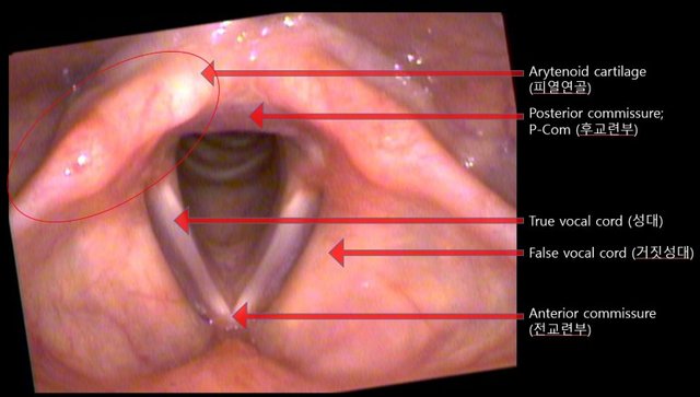 vocalcord.jpg