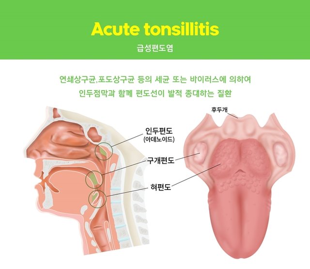 급성편도염 치료 광화문한의원 통인한의원.jpg