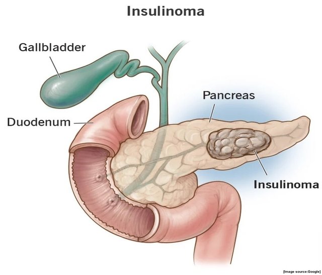 Insulinoma and Other Pancreatic Disorders.jpg