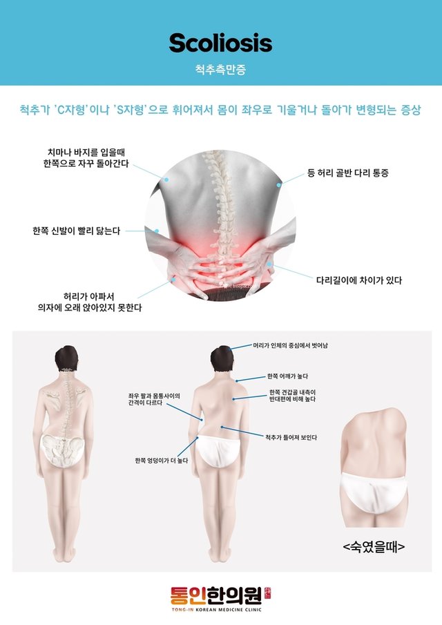 척추측만증.jpg