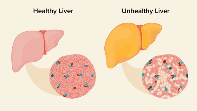 12223-Everything_You_Need_to_Know_About_Fatty_Liver-header-1297x729-1.jpg