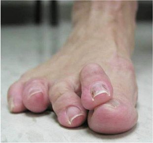 hammertoe.jpg