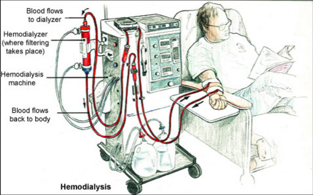 hemodialysis illustration.PNG