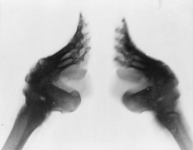 960px-Bound_feet_(X-ray).jpg