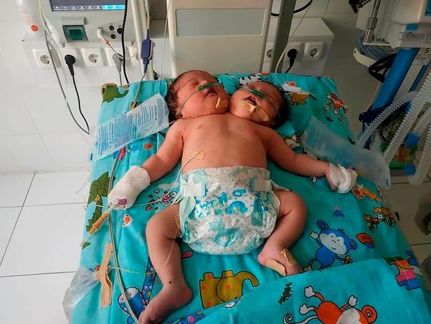 0_PAY-Samarkand-two-headed-baby-1-east2west-news.jpg