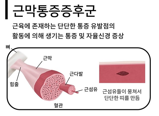 옆구리 통증 근막동통증후군 통인한의원.jpg