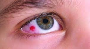 Global Intraocular Melanoma Treatment Market.jpg