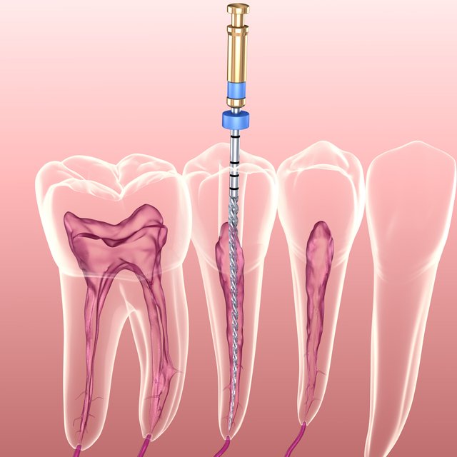 Debunking 6 Myths About the Root Canal Procedure.jpg