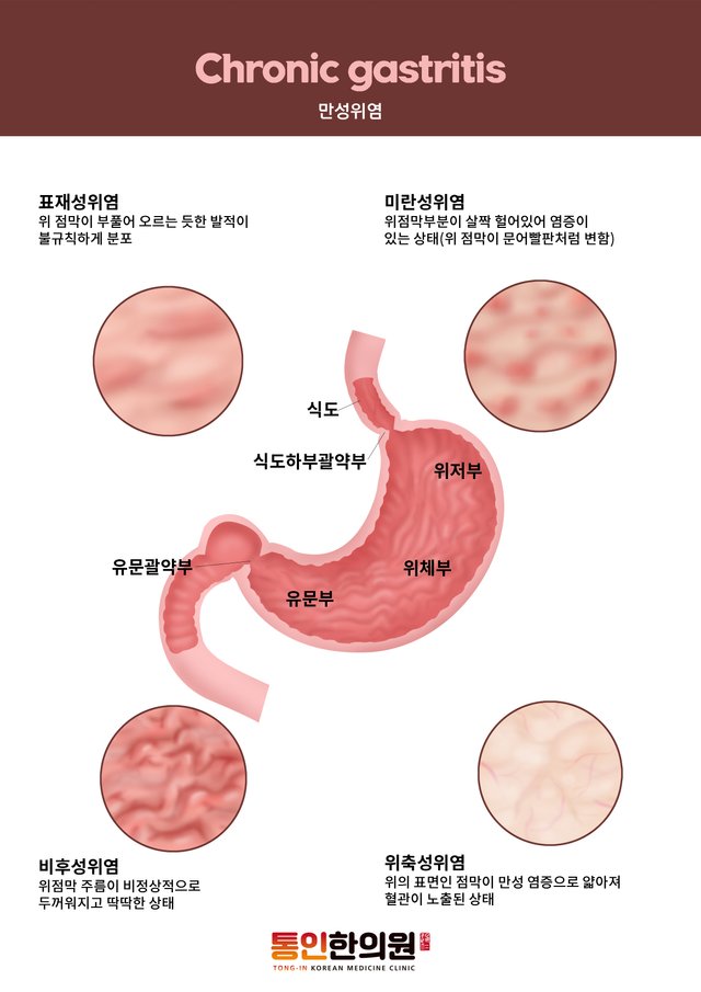 만성위염.jpg