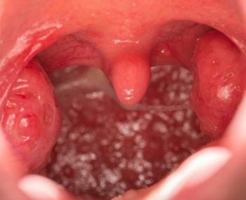 10-02-38-open-mouth-view-of-tonsils.jpg