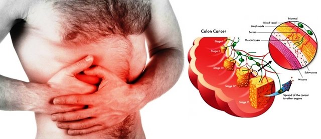 Warning-Signs-and-Symptoms-of-Colon-Cancer.jpg